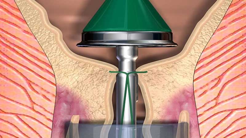 درمان بواسیر با استاپلر
