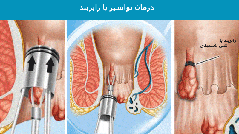 درمان بواسیر با رابربند