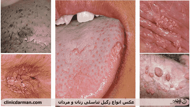 عکس زگیل تناسلی