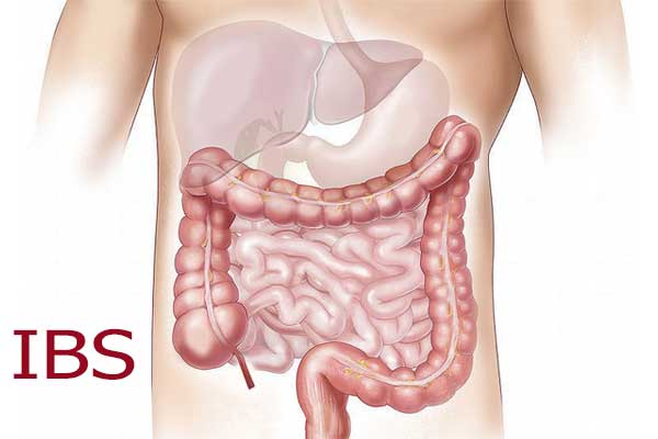 علائم سندروم روده‌‌ تحريک پذير یا IBS چیست؟