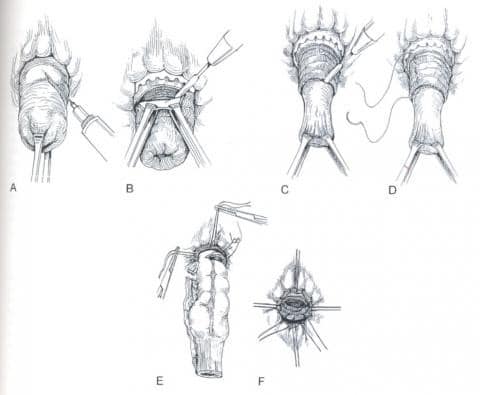 برداشتن مخاط به روش دلورمه