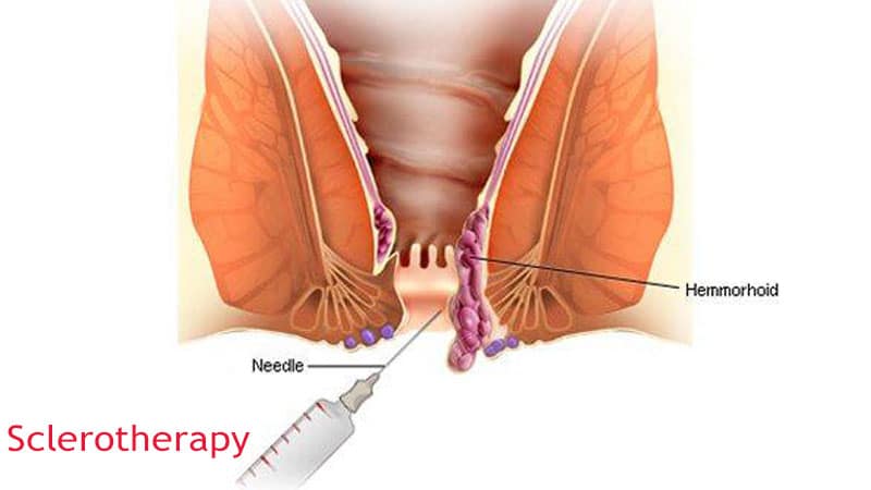 اسکلروتراپی