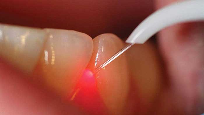 کاربرد لیزر در دندانپزشکی