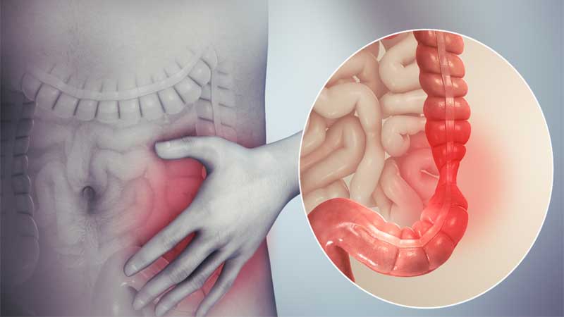 استرس و روده تحریک پذیر