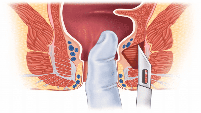 دیلاتاسیون شقاق