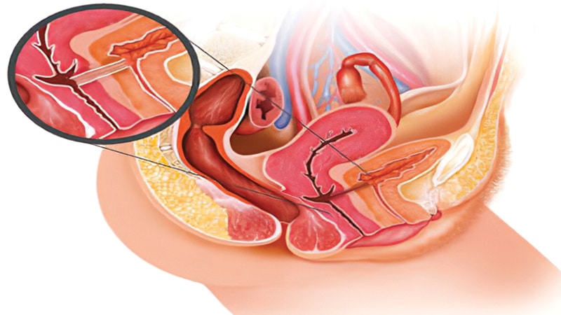 بیماری فیستول در زنان – علائم، دلایل و درمان فیستول واژن