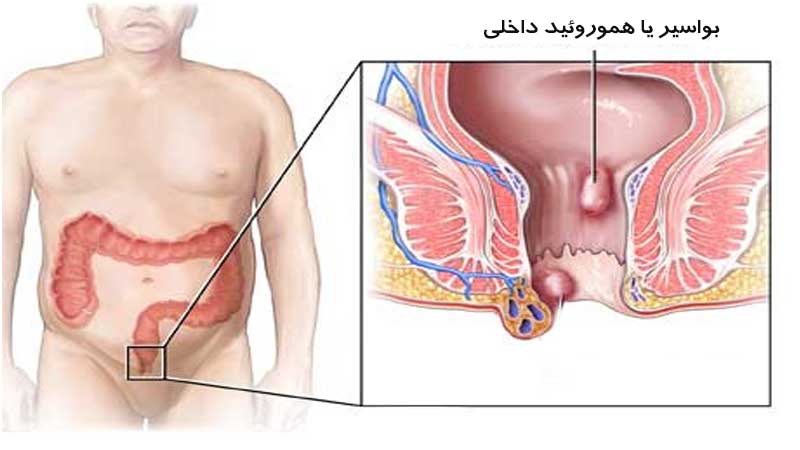 بواسیر داخلی، علائم هموروئید درجه 4،3،2،1 و راه درمان