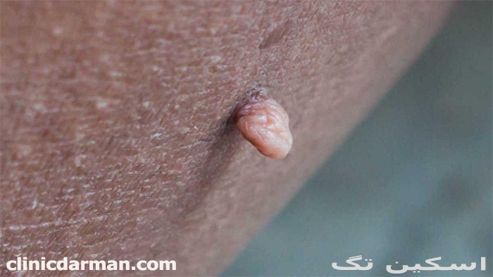 vaginal skin tag