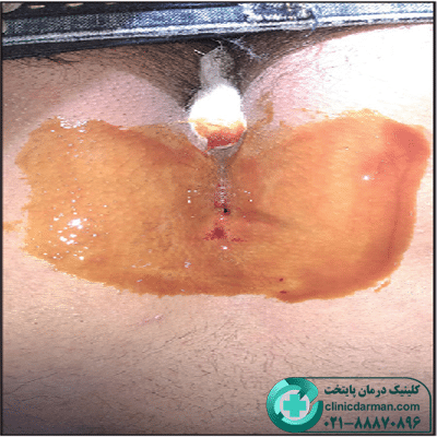 تزریق فنل کیست مویی