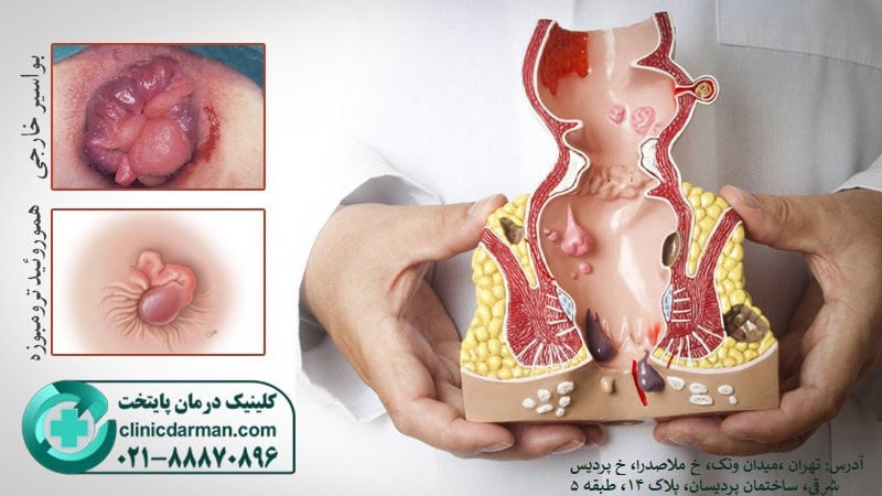 درمان بواسیر خارجی