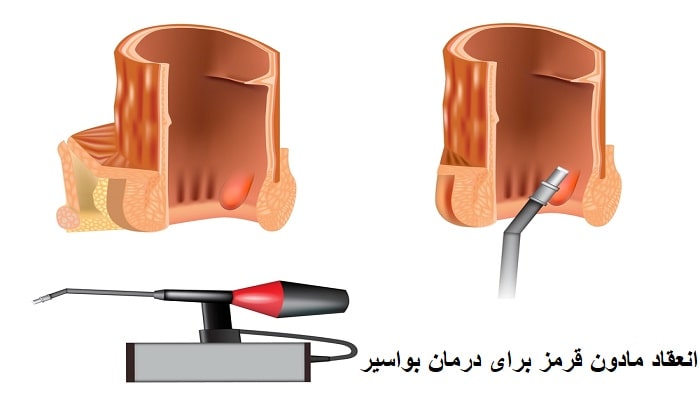 انعقاد مادون قرمز برای درمان بواسیر