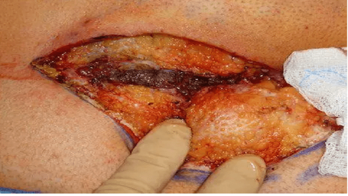 ترمیم زخم باز کیست مویی