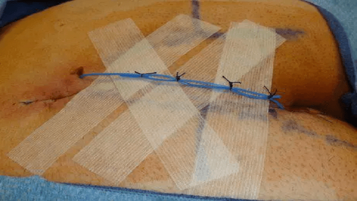 درمان زخم کیست مویی بعد از عمل