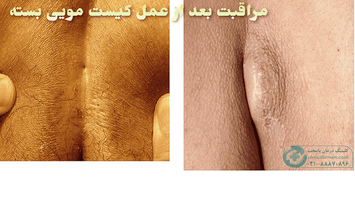 مراقبت بعد از عمل کیست مویی بسته