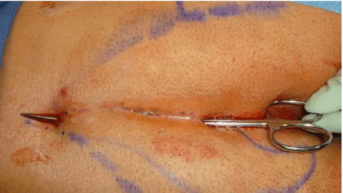 دوران نقاهت بعد از عمل کیست مویی باز