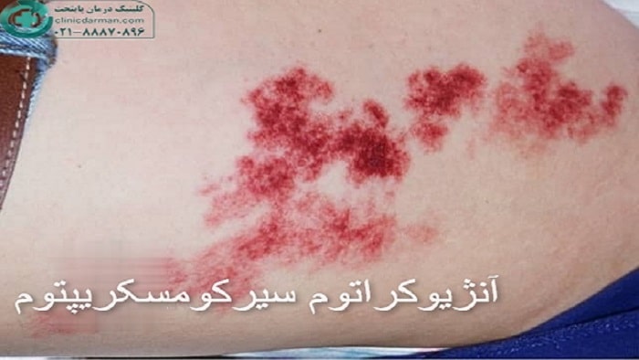 آنژیوکراتوم سیرکومسکریپتوم