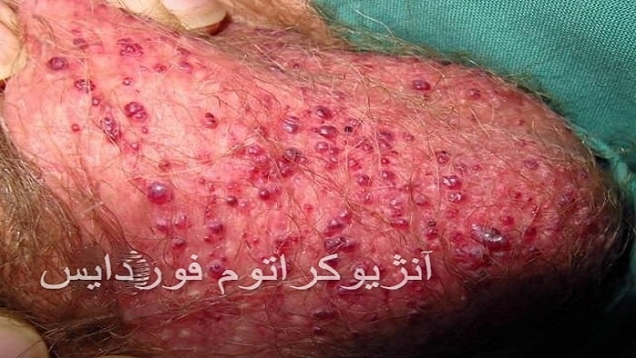 آنژیوکراتوم فوردایس