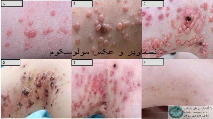 عکس مولوسکوم