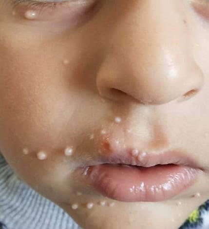 مولوسکوم در کودکان