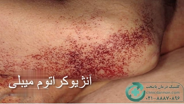 آنژیوکراتوم میبلی