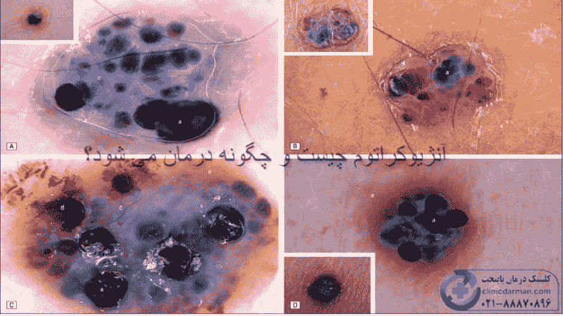 آنژیوکراتوم چیست