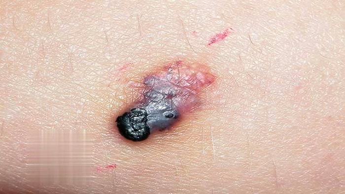 آنژیوکراتوم