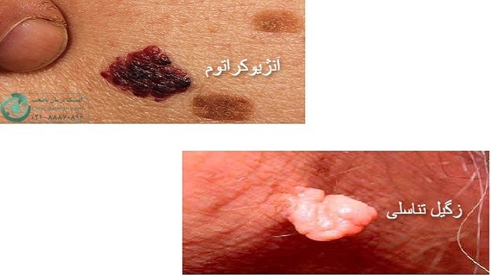 تفاوت آنژیوکراتوم با زگیل تناسلی
