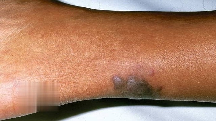 علائم آنژیوکراتوم در زنان و مردان