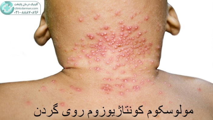 علائم مولوسکوم