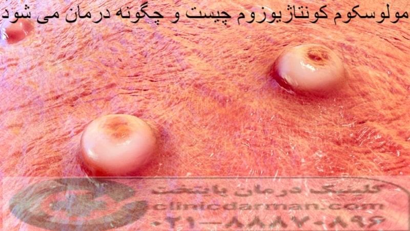 مولوسکوم کونتاژیوزوم