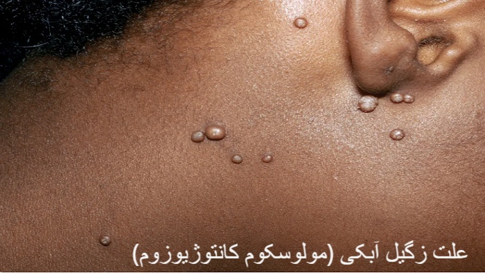 علت مولوسکوم چیست