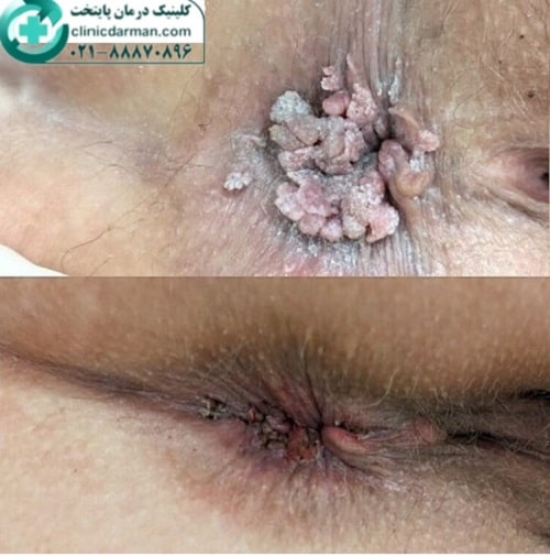 عکس زگیل داخل مقعدی زنان