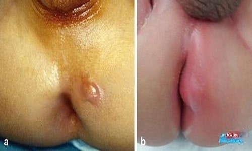 عکس بیماری آبسه مقعدی