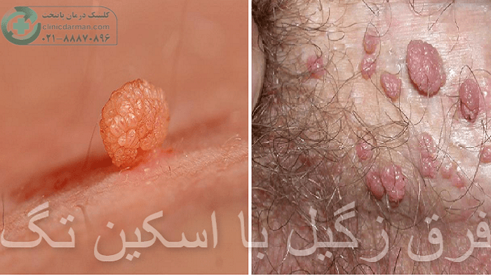 تفاوت اسکین تگ با زگیل