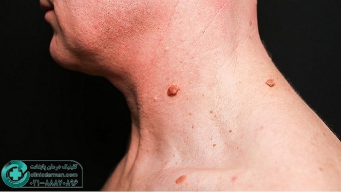 علت ایجاد اسکین تگ