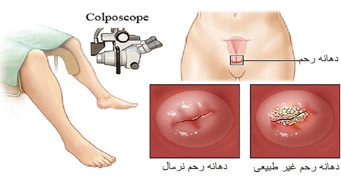 کولپوسکوپی برای چیست
