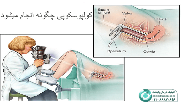 کولپوسکوپی چگونه انجام میشود