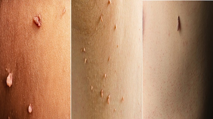 عکس اسکین تگ یا منگوله پوستی