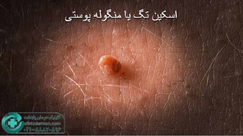 منگوله پوستی چیست