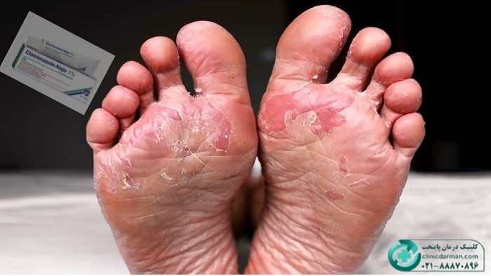 پماد کلوتریمازول برای عفونت پای ورزشکاران