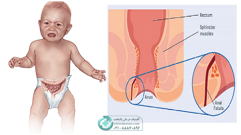 بیماری فیستول در کودکان