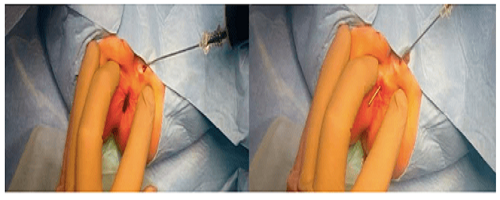 عکس جراحی فیستول مقعدی در کودکان