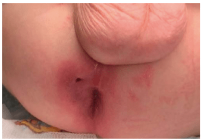 عکس فیستول در کودکان بعد از تخلیه