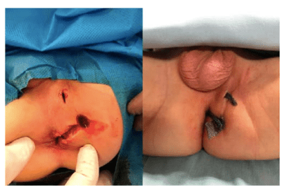 عکس بعد از عمل فیستول کودکان