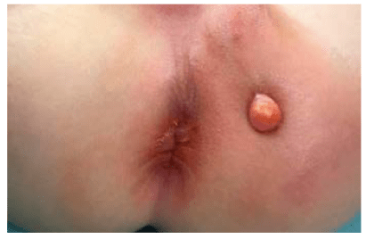 عکس فیستول کودکان به همراه آبسه