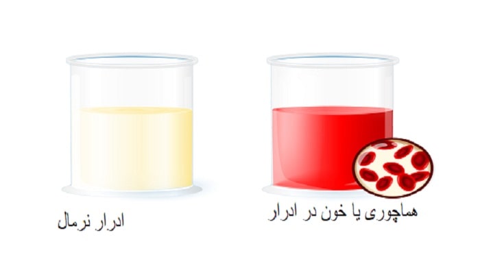 خون در ادرار خطرناکه؟