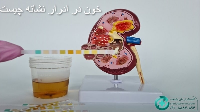 علت خون در ادرار