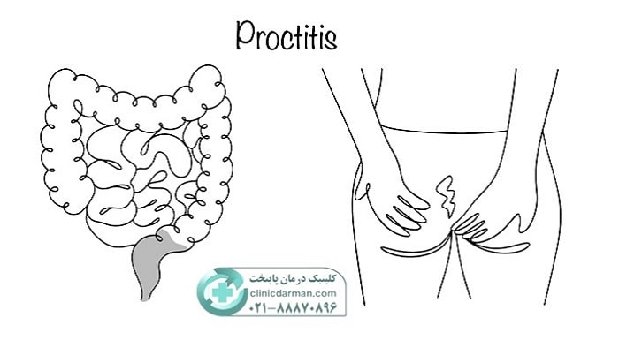 پروکتیت مزمن