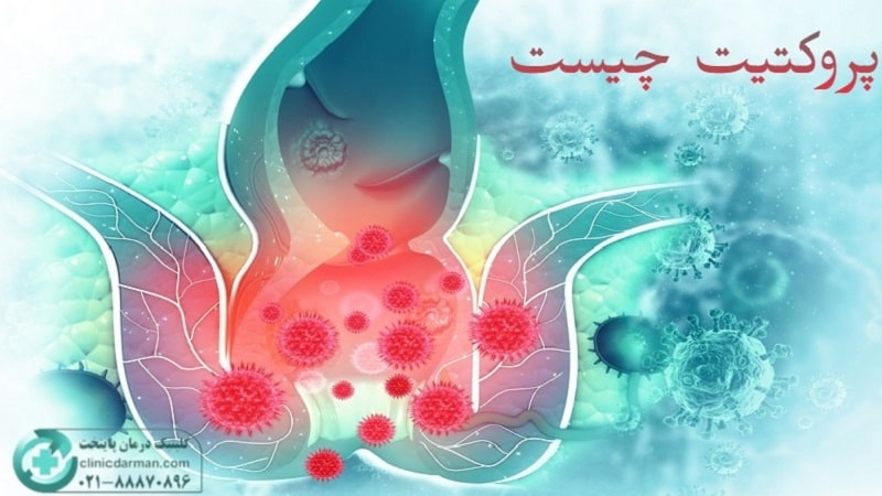 پروکتیت چیست