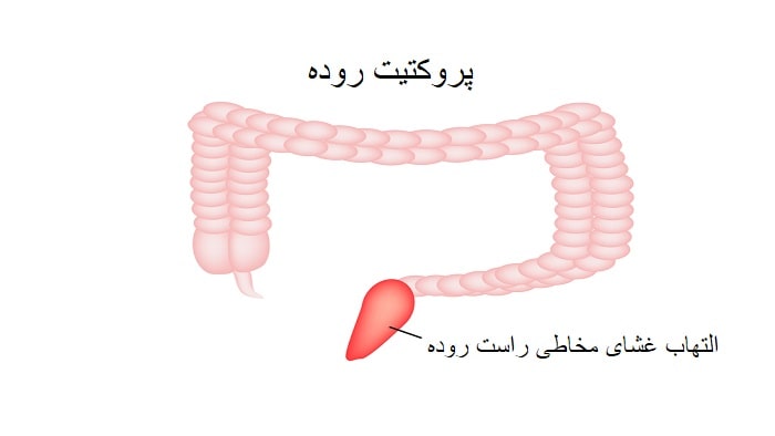 انواع پروکتیت